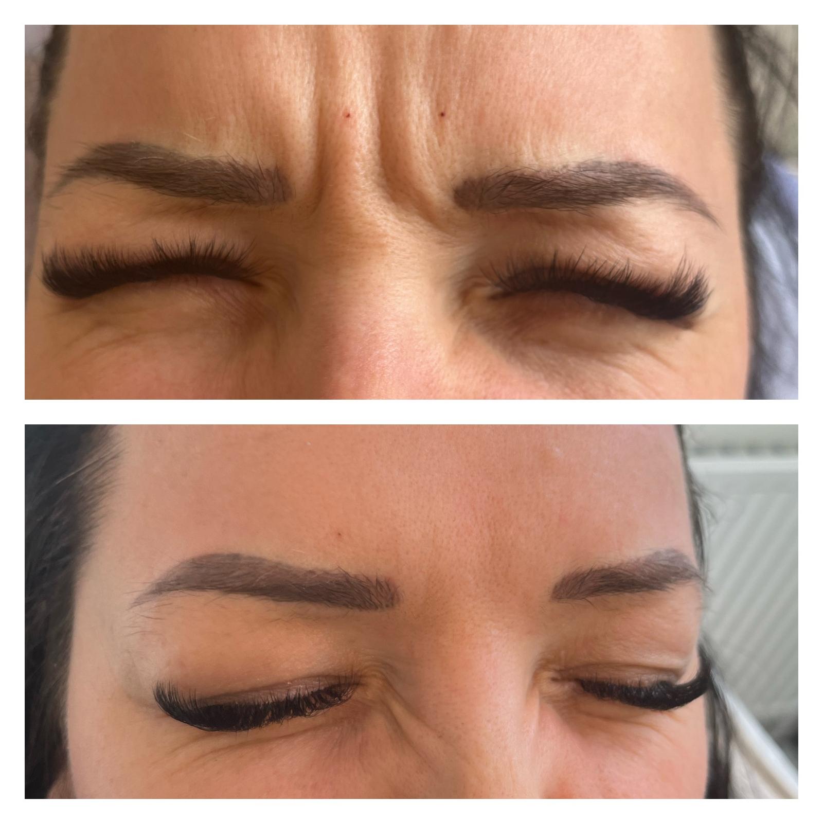 Botox Anti Wrinkle Treatment