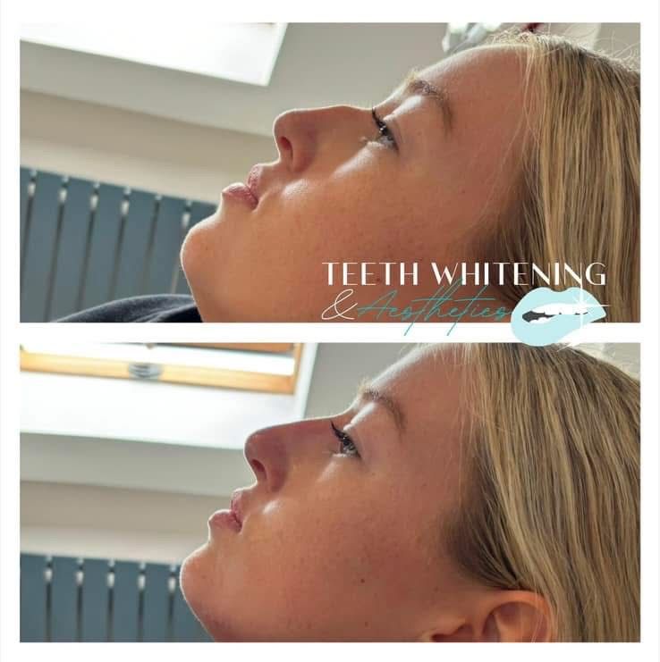 Dermal filler treatment result