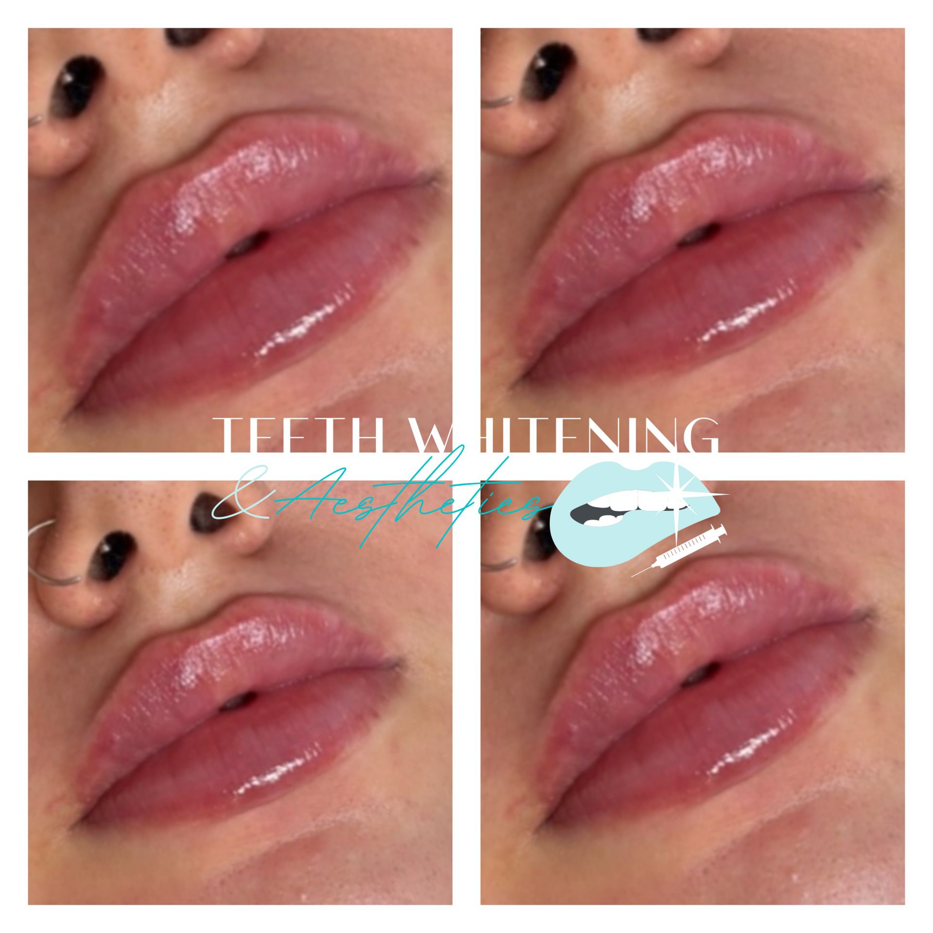 Lip filler result 1