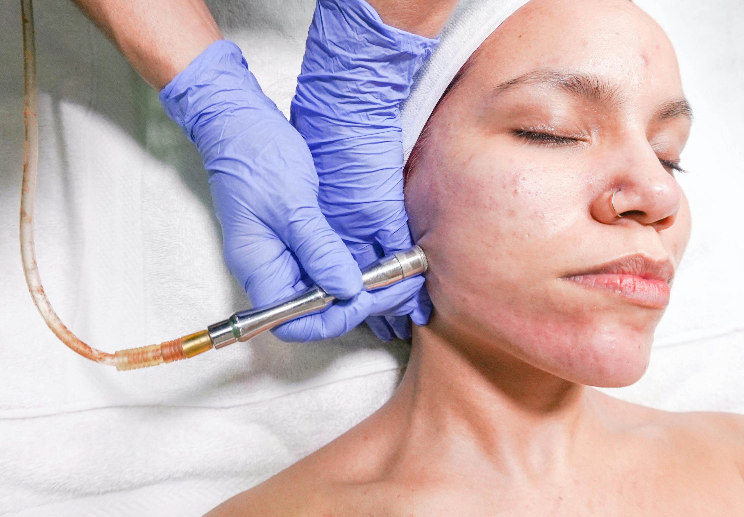 Microdermabrasion