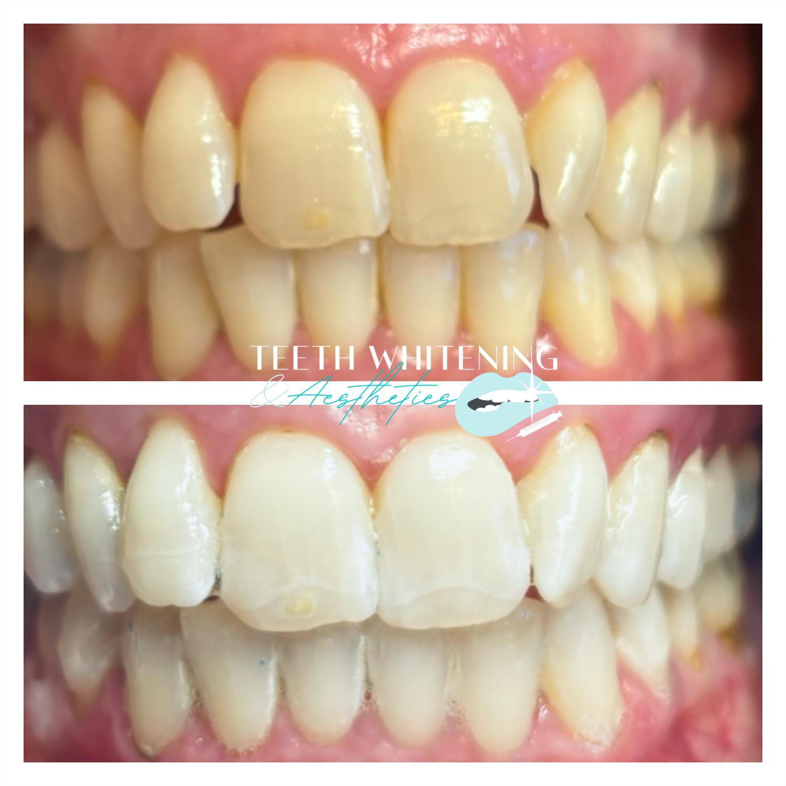 Teeth Whitening Treatment