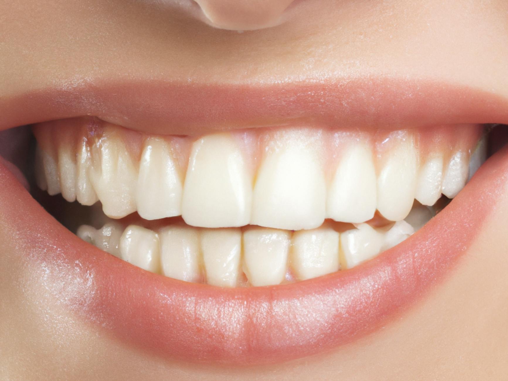 Teeth Whitening Treatment