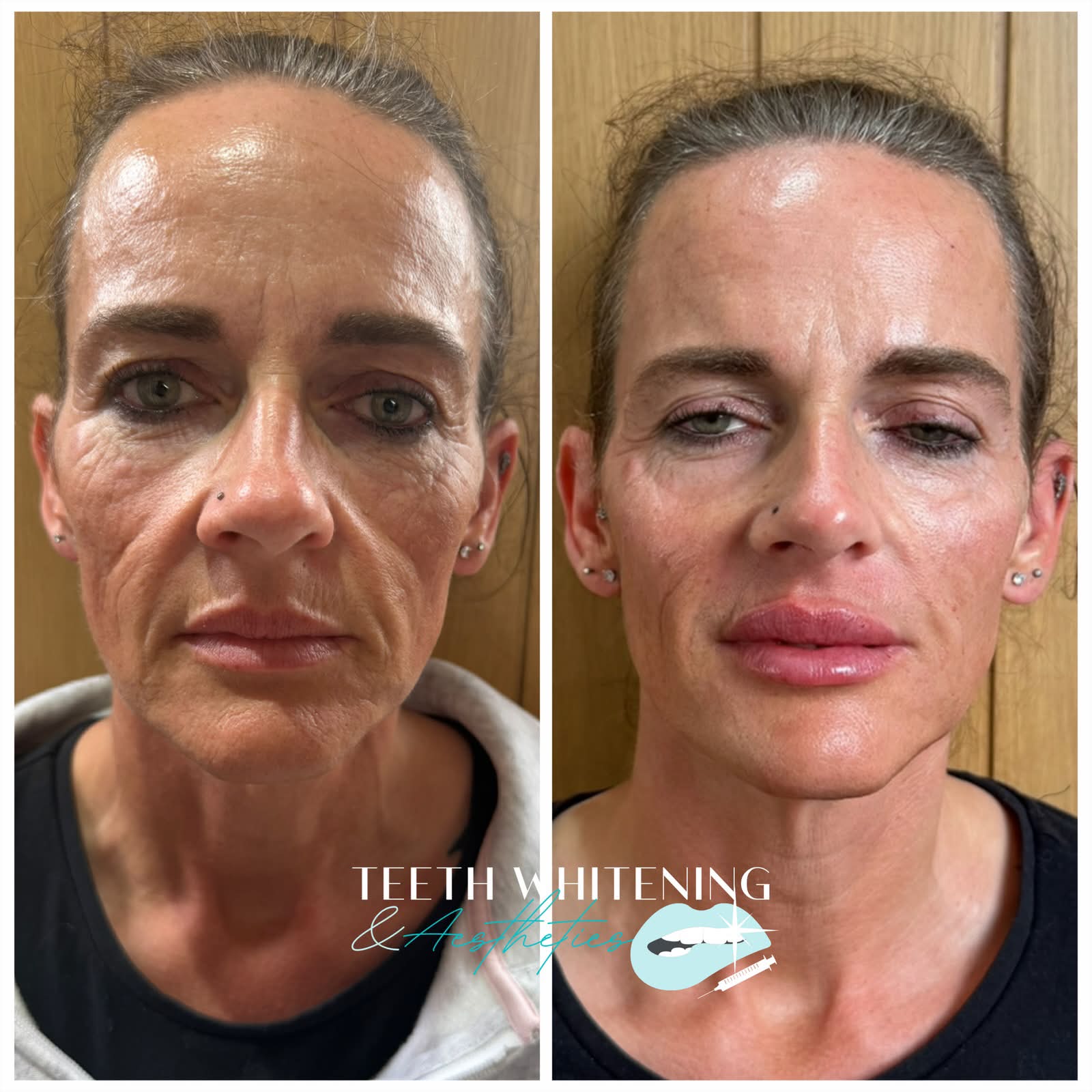 Fillers before and after result