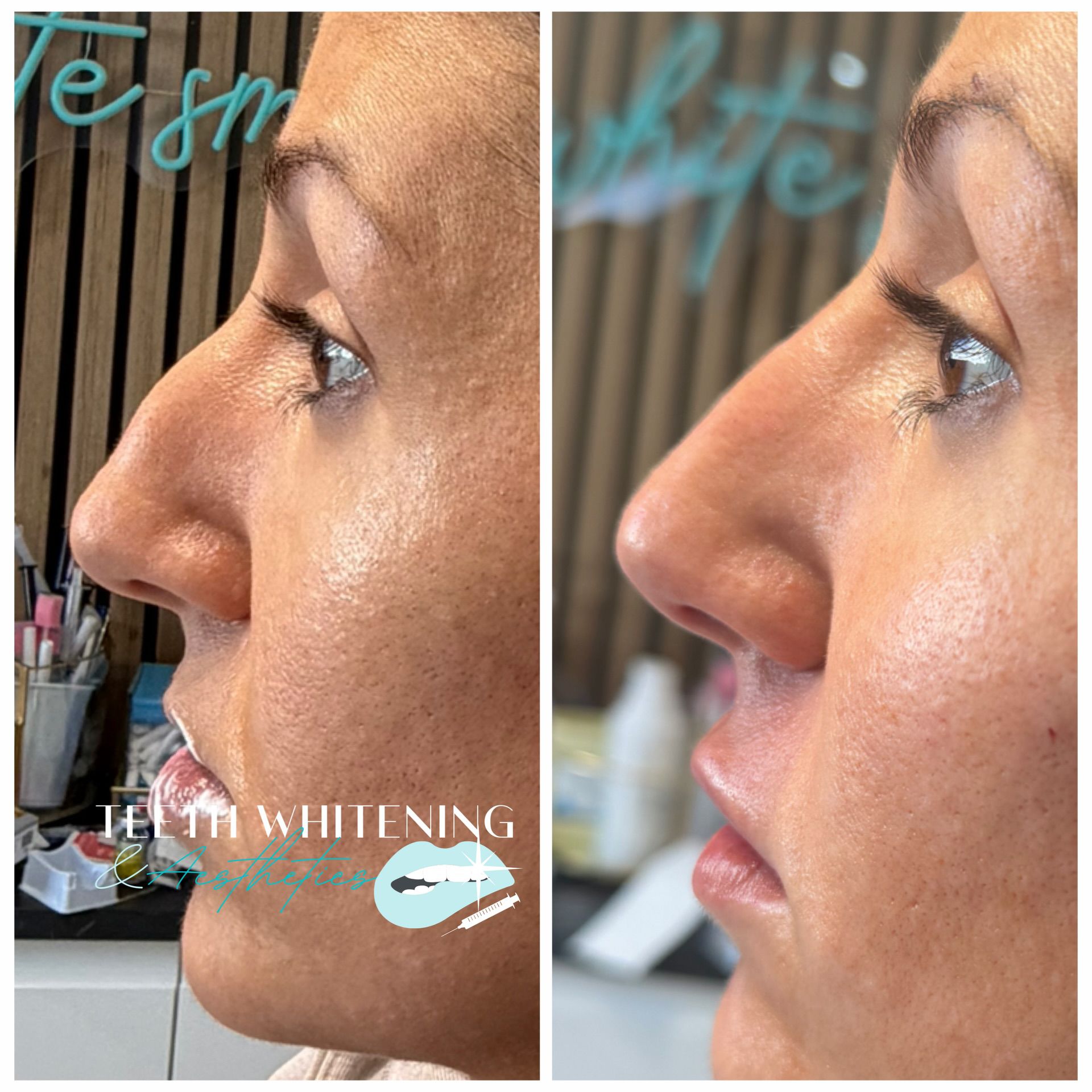 Liquid rhinoplasty before and after result