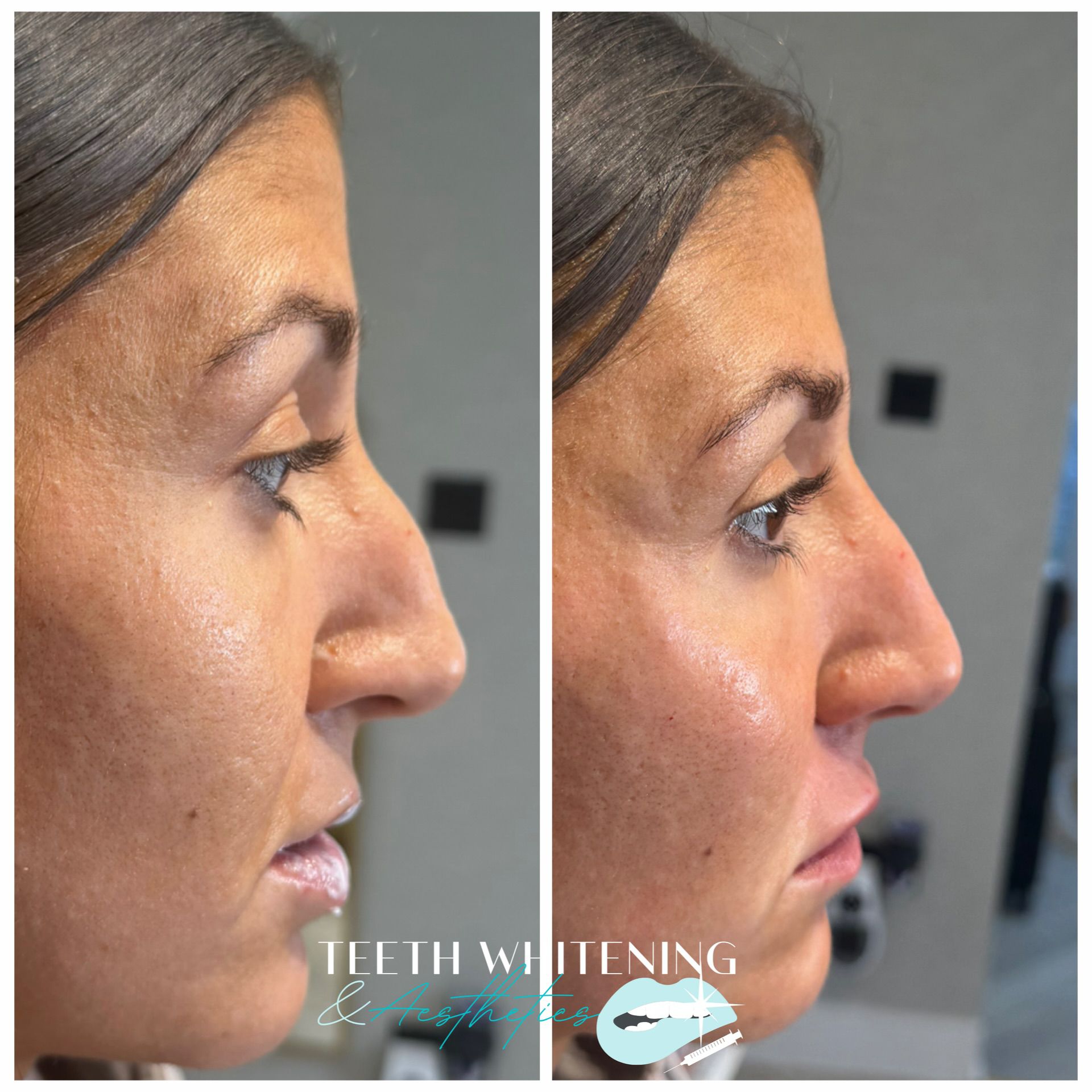 Liquid rhinoplasty before and after result 2