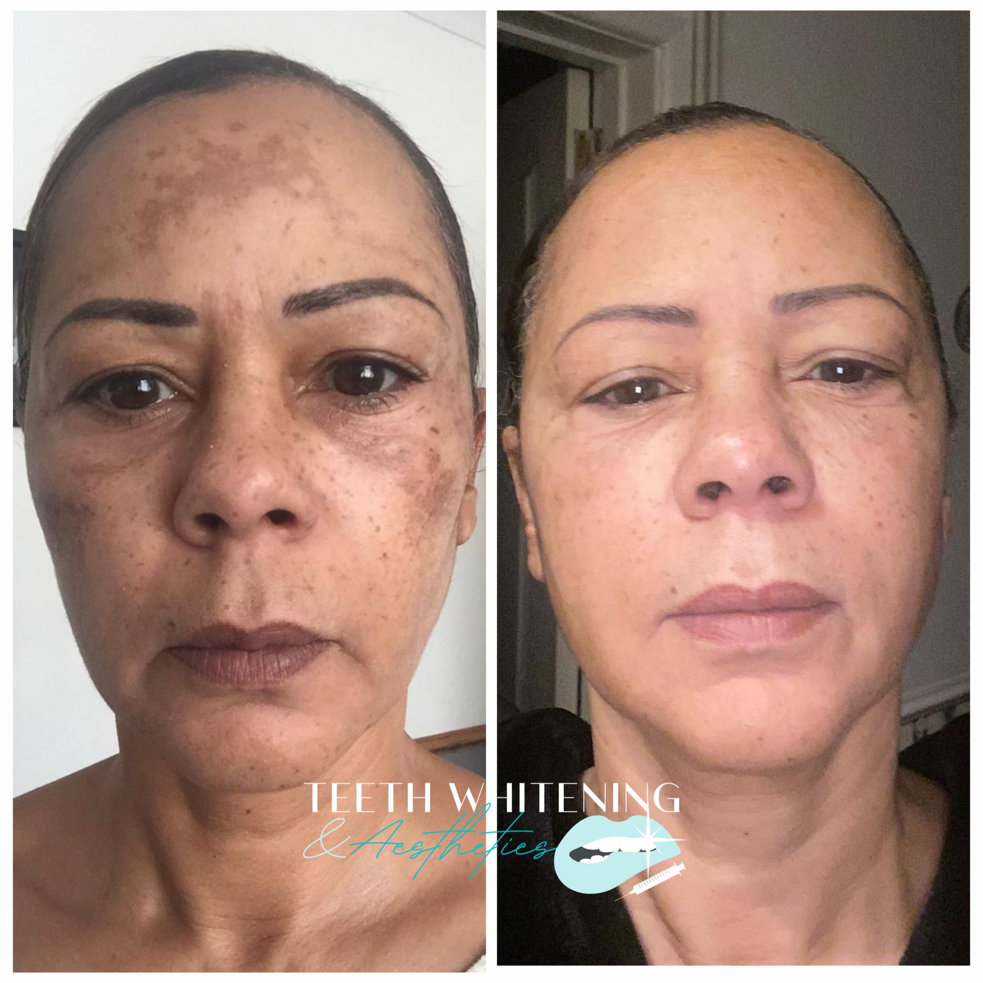 Microdermabrasion before and after result
